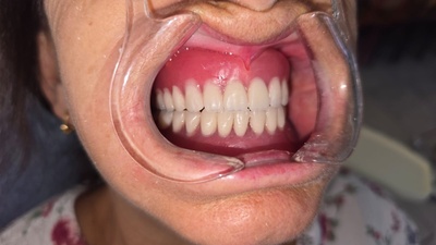 Complete Removable Prosthetic Rehabilitation Using the Piezography Technique