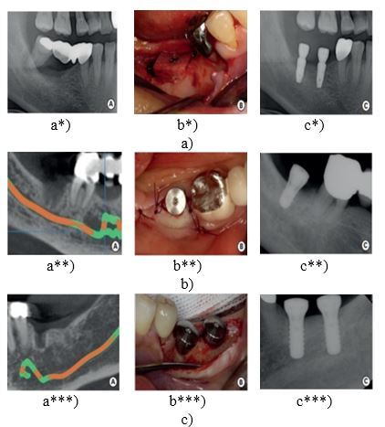 Short Implant: A New Normal in Implant Dentistry-Review Article