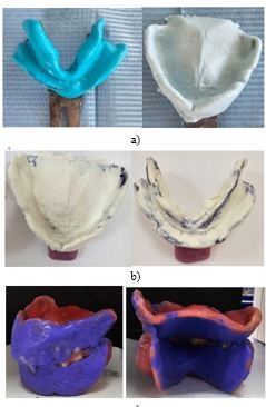 Comparison of Conventional and Piezography Techniques for Removable Dentures Using the Albanian OHIP-EDENT