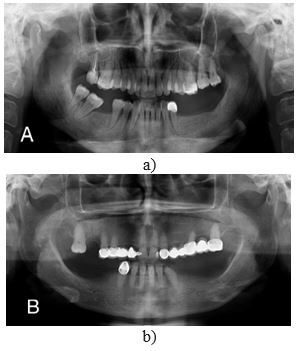 Semi-Digital Workflow of Removable Partial Denture Fabrication for Scleroderma-Induced Microstomia Patients: Two Clinical Reports