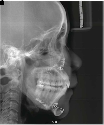 Three-Dimensional Skeletal Stability in Le Fort I Osteotomy: A Comparative Cohort Study