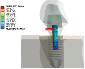 Socket Shield Technique: Stress Distribution Analysis