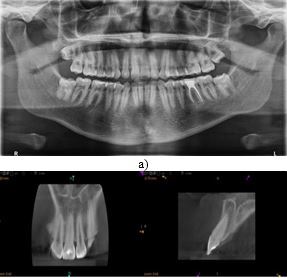 Managemento Post Orthodontic Extensive Root Canal Calcification and Crown white-Spot-Lesions Using Resin Infiltration Technique
