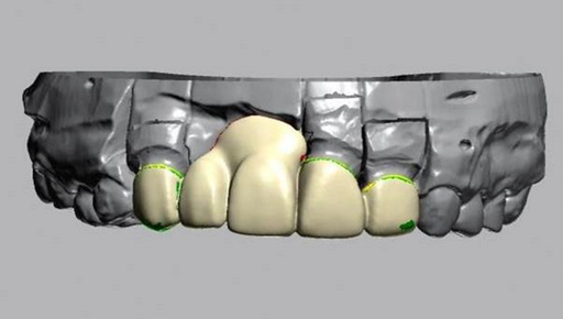 Esthetic Rehabilitation with Rapid Maxillary Expansion, Lefort Osteotomy, and Gingival Veneer Prosthesis: A Case Report