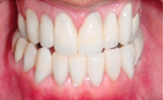 Multidisciplinary Course of Action in Treating an Intricate Dental Condition: A Case Report