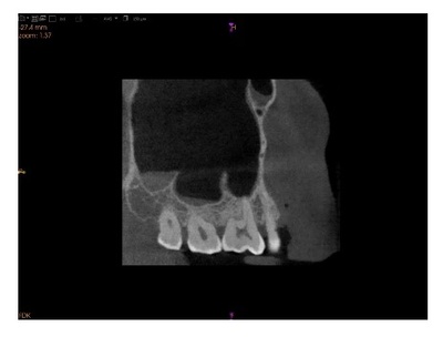 Cone-Beam Computed Tomographic Evaluation of Maxillary Sinus Anatomy and Septal Variations: Clinical Implications for Surgical Safety