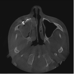 Multidisciplinary Management of Zygomatic Fractures: A Case Report From Kok-Boru Sports Injury from Kyrgyzstan