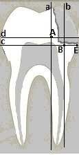 Harnessing the Power of Laser Doppler Flowmetry of Tooth Pulp and Densitometry at Dental Caries