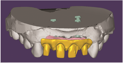 3d Printed Customized CAD-CAM Implant Abutment for Correction of Angulated Implant in Esthetic Zone-A Case Report