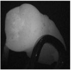 Fluorescent Diagnostics of Microscopic Damage to Tooth Enamel Using an Innovative Mixture of Silver Nanoparticles