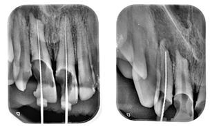 Amnion Membrane Matrix and Bio Dentine in the Management of an External Apical Root Resorption