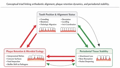 Orthodontic Alignment as a Modifier of Periodontal Risk: Conceptualizing the Interdependence Between Tooth Position, Plaque Retention, and Periodontal Stability