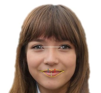 Photographic Analysis of Lip Fillers with Hyaluronic Acid