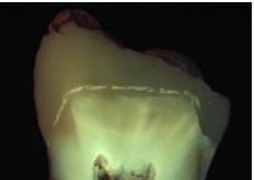 Evaluation of Microleakage and Fatigue Behaviour of Several Fiber Application Techniques in Composite Restorations