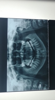 Orthodontic Treatment of a Class I Malocclusion with Agenesis and Impaction of the Mandibular Lateral Incisors