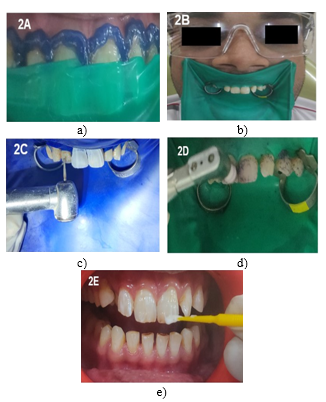 Management of Enamel Stains Using a Combination Technique of Microabrasion and Remineralizing Agent