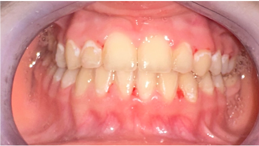 Treatment of Growing Skeletal Class III Malocclusion Using Maxillary Expansion and Intermaxillary Elastics