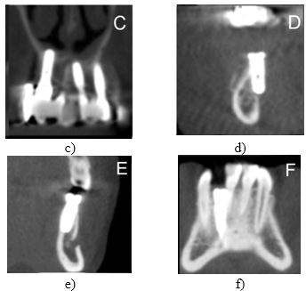Retrospective Assessment of Dental Implant-Related Anatomical Structure Perforations Using Cone Beam Computed Tomography