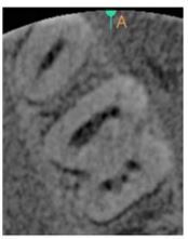 Application of Cone-Beam Computed Tomography in Diagnosis and Treatment of Multiple Canals&ndash; A Case Report