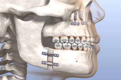 Effects of Orthognathic Surgery on Airway Dimension and Sleep Apnea Outcome: A Systematic Review