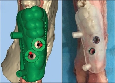 Accuracy of Computer-Assisted Surgery in Immediate Implant Placement an Experimental Study
