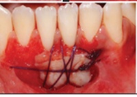 Collagen Matrix Versus Free Gingival Graft for Augmentation of Keratinized Tissue in Mandibular Anterior Teeth: A Comparative Clinical Study