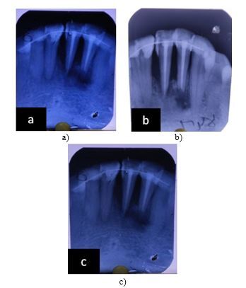 Intentional Replantation with Simultaneous Periapical Surgery- A Case Report with One Year of Follow-Up