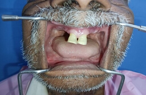 Tooth Supported Overdenture in Old Patient with Denture Characterizaton- A Case Report